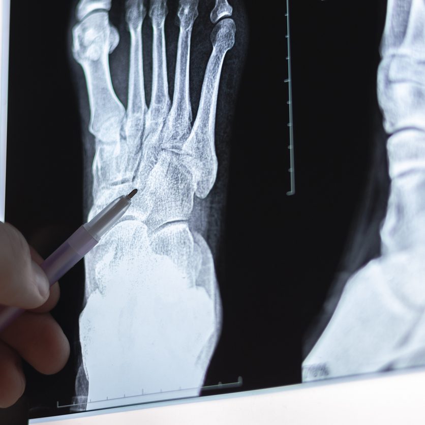 Doctor learning X-ray of foot fingers. Radiography foot bones. Metatarsal, Tarsals, Phalanges bone. Treatment of Sprains and dislocations of the muscles and bones of the foot.